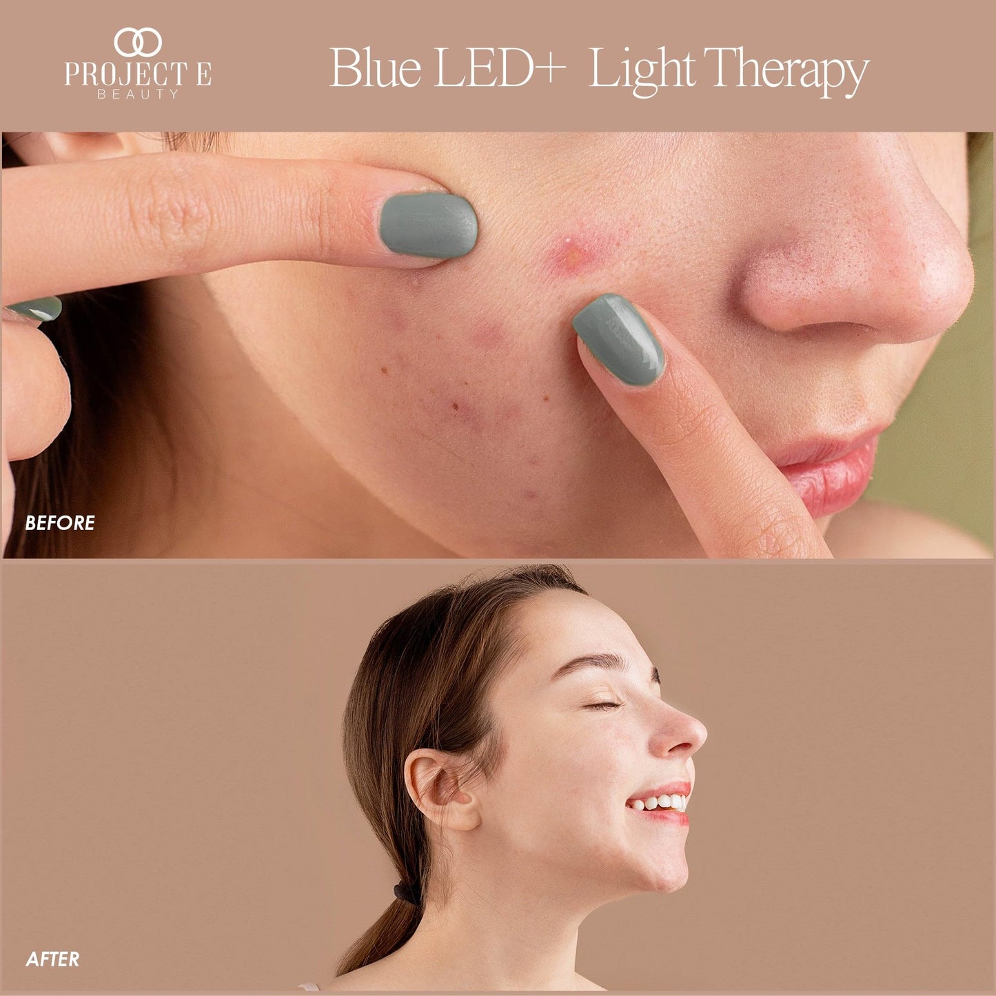 Blue LED+ Acne Light Therapy by Project E Beauty